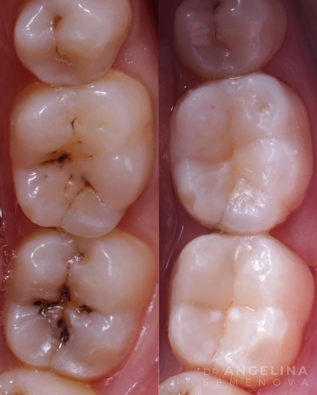 Close-up view of dental teeth showing cavities and healthy enamel on adjacent molars.