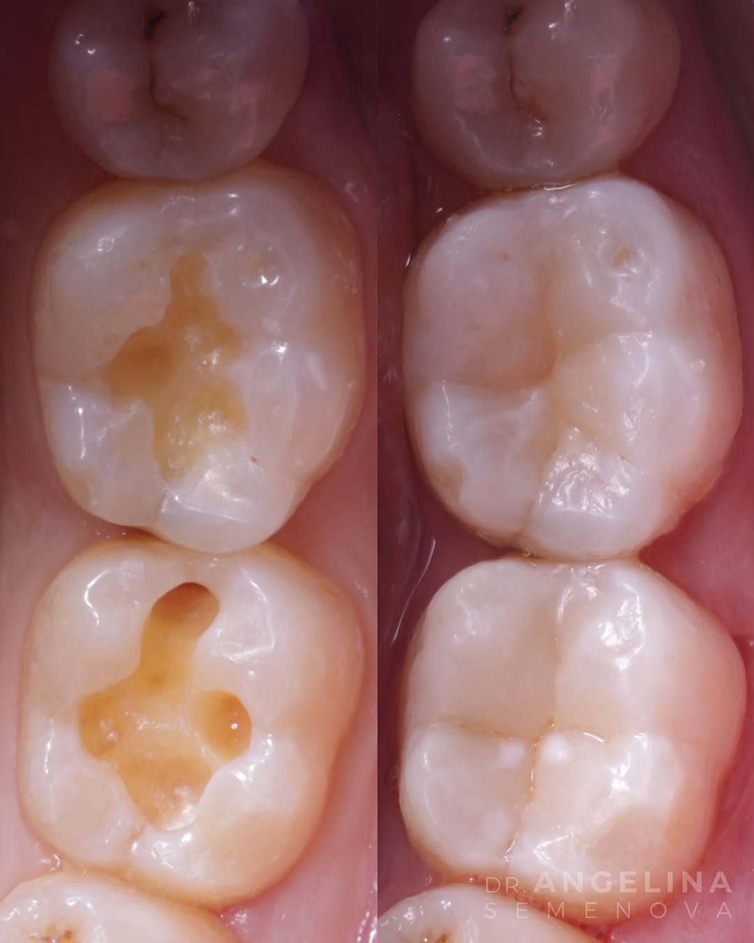 Close-up view of dental cavities on molars, showcasing the affected areas and healthy tooth structure.