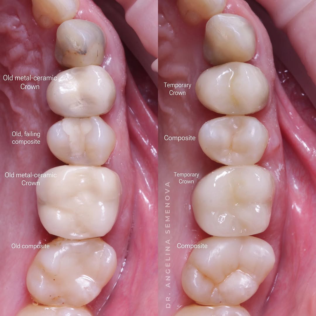 Comparison of dental crowns showing old metal-ceramic crowns and temporary crowns alongside new composite restorations.