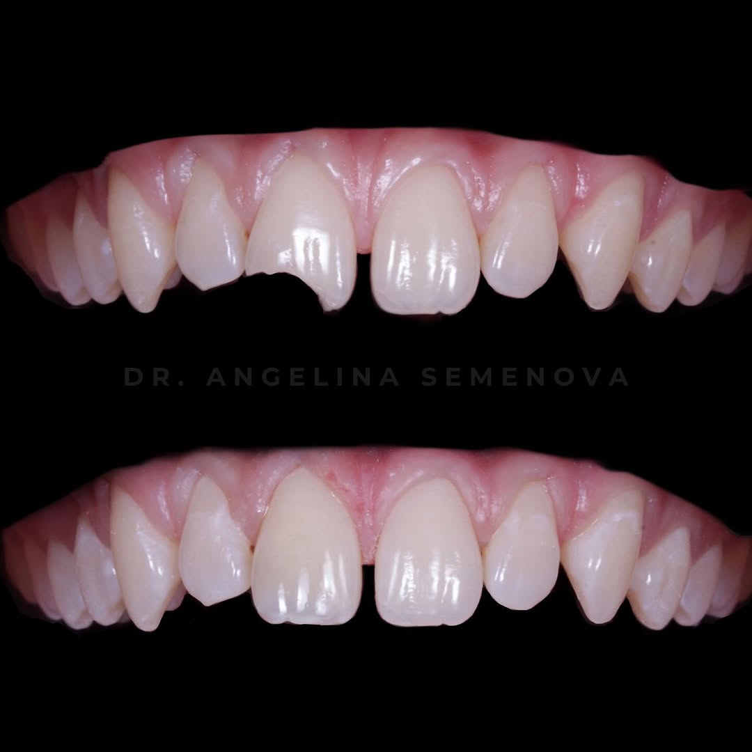 Close-up view of a dental treatment showcasing a set of teeth with a focus on their alignment and appearance.