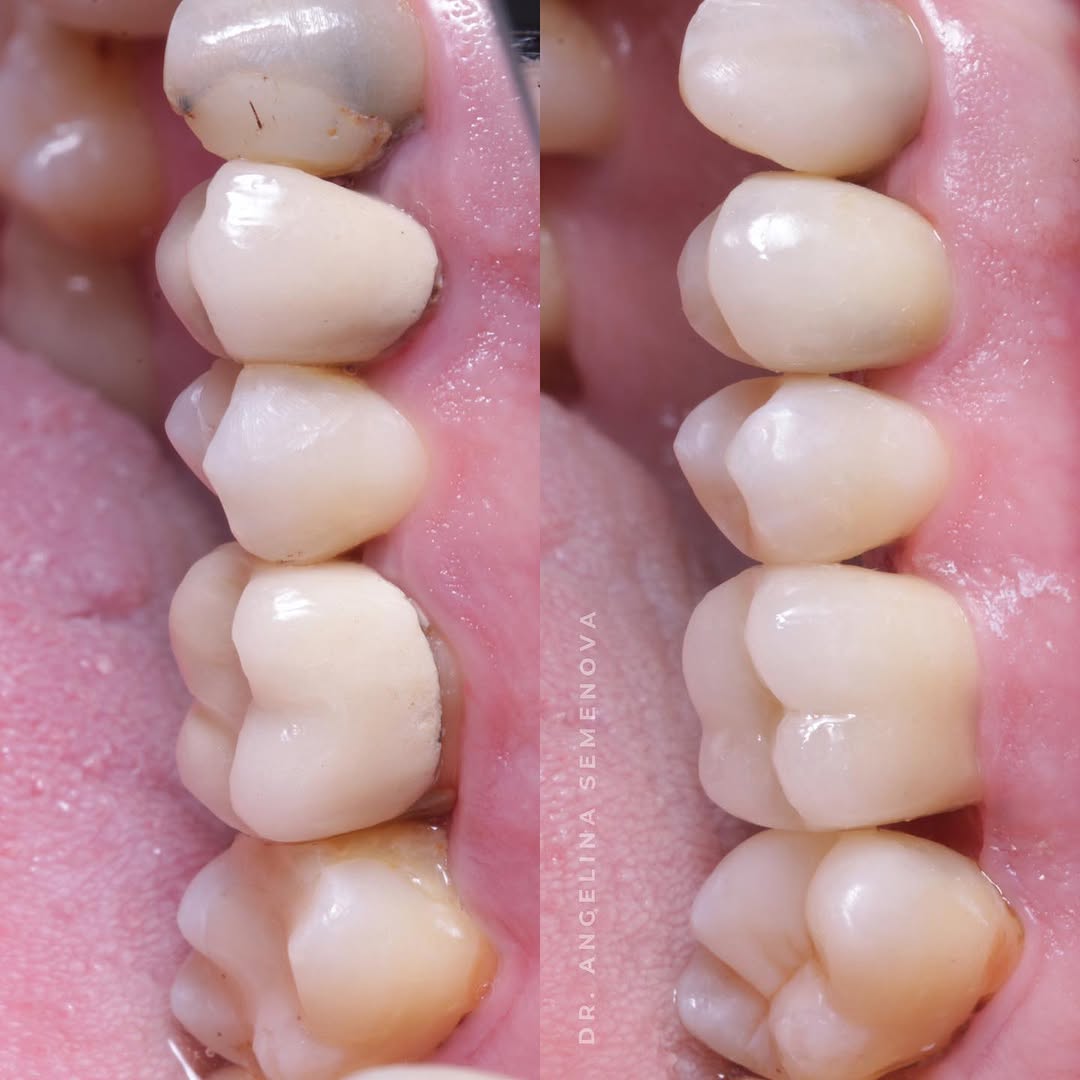 Close-up view of a dental restoration showing the alignment and condition of teeth.