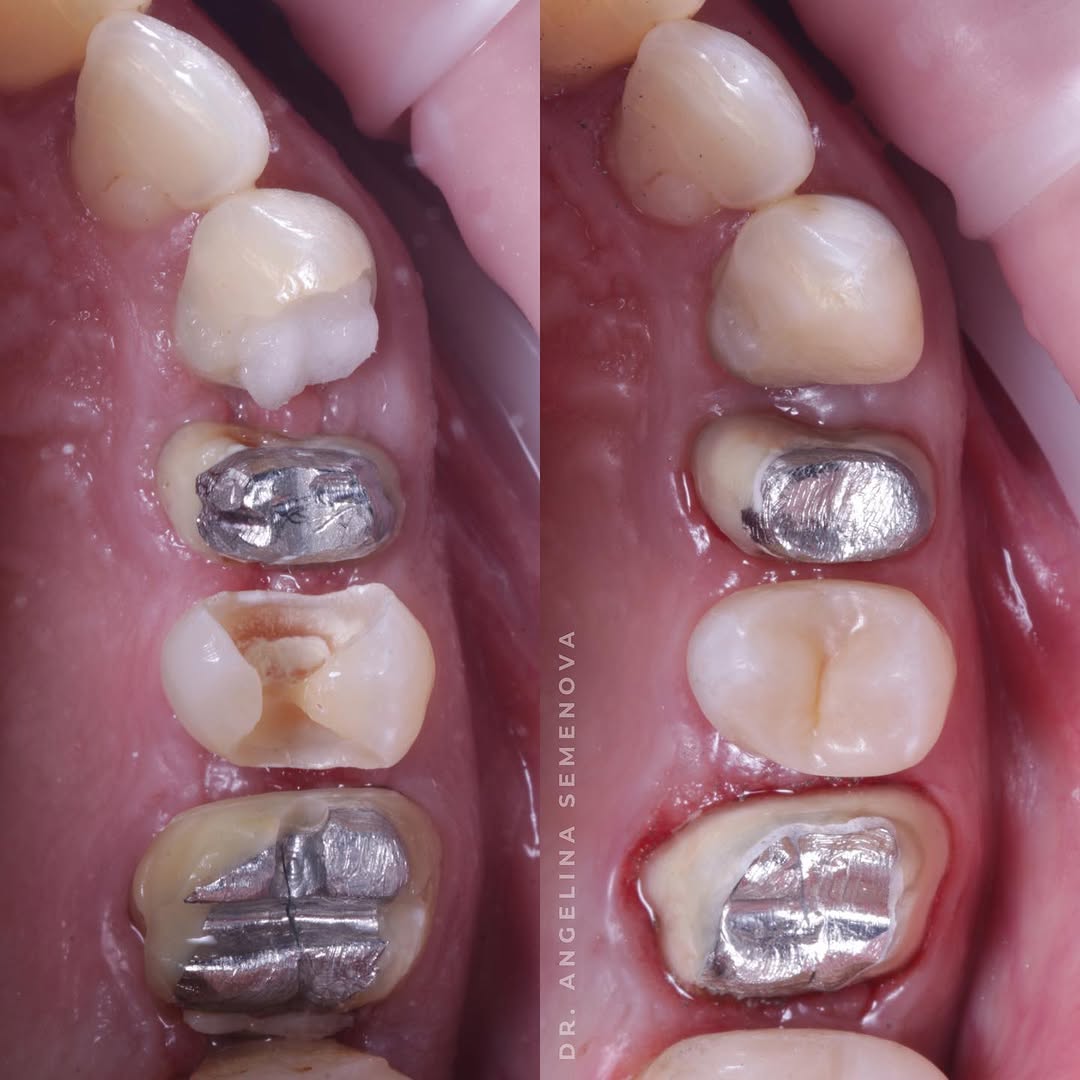A close-up view of dental work showing before and after images of a tooth restoration with silver fillings.